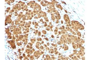 Formalin-fixed, paraffin-embedded human Melanoma stained with S100B Mouse Monoclonal Antibody (S100B/1012). (S100B 抗体)