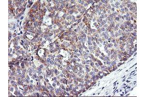 Immunohistochemical staining of paraffin-embedded Adenocarcinoma of Human ovary tissue using anti-NMT2 mouse monoclonal antibody. (NMT2 抗体)