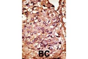 Formalin-fixed and paraffin-embedded human cancer tissue reacted with the primary antibody, which was peroxidase-conjugated to the secondary antibody, followed by AEC staining. (CCBP2 抗体  (AA 54-84))