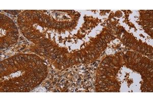 Immunohistochemistry of paraffin-embedded Human colon cancer tissue using MFAP3L Polyclonal Antibody at dilution 1:50 (MFAP3L 抗体)