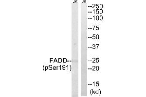Immunohistochemistry analysis of paraffin-embedded human breast carcinoma tissue, using FADD (Phospho-Ser191) antibody.