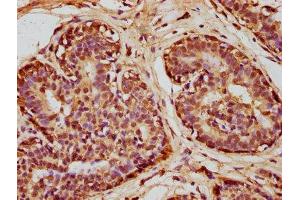 IHC image of ABIN7170979 diluted at 1:100 and staining in paraffin-embedded human breast cancer performed on a Leica BondTM system. (SOD1 抗体  (AA 2-154))