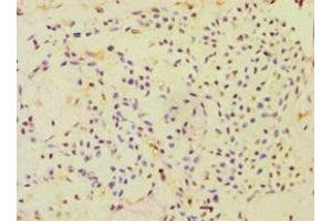 Immunohistochemistry of paraffin-embedded human breast cancer using ABIN7151000 at dilution of 1:100 (CBLC 抗体  (AA 245-474))