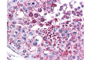 Immunohistochemistry (IHC) image for anti-Melanoma Antigen Family A, 3 (MAGEA3) (Middle Region) antibody (ABIN2782498) (MAGEA3 抗体  (Middle Region))