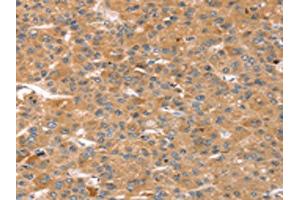 The image on the left is immunohistochemistry of paraffin-embedded Human liver cancer tissue using ABIN7128752(CAPN7 Antibody) at dilution 1/20, on the right is treated with fusion protein. (Calpain 7 抗体)