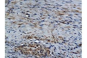 Formalin-fixed and paraffin embedded human colon carcinoma labeled with Rabbit Anti GM-CSF Polyclonal Antibody, Unconjugated (ABIN704156) at 1:200 followed by conjugation to the secondary antibody and DAB staining (GM-CSF 抗体  (AA 65-144))