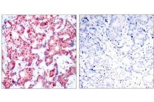 Immunohistochemical analysis of paraffin-embedded human breast carcinoma tissue using GATA1(Phospho-Ser142) Antibody(left) or the same antibody preincubated with blocking peptide(right). (GATA1 抗体  (pSer142))