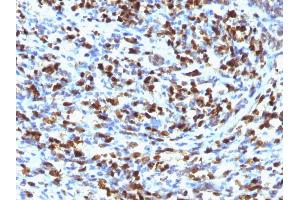 Formalin-fixed, paraffin-embedded human Rhabdomyosarcoma stained with Myogenin Mouse Monoclonal Antibody (MGN185).
