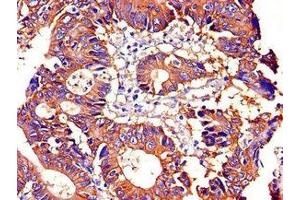 Immunohistochemistry of paraffin-embedded human colon cancer using ABIN7170036 at dilution of 1:100