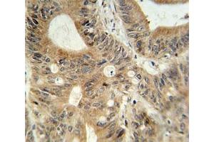 ABCC3 antibody immunohistochemistry analysis in formalin fixed and paraffin embedded human colon carcinoma. (ABCC3 抗体  (AA 899-925))