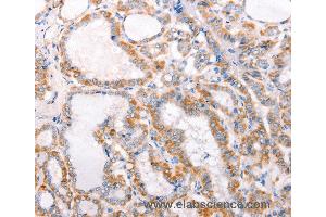 Immunohistochemistry of Human thyroid cancer using TRAF5 Polyclonal Antibody at dilution of 1:30