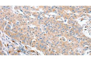 Immunohistochemistry of paraffin-embedded Human gastric cancer using WNT3A Polyclonal Antibody at dilution of 1:40 (WNT3A 抗体)