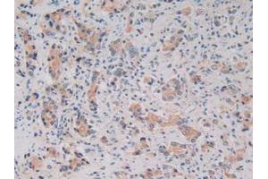 IHC-P analysis of Human Prostate Gland Cancer Tissue, with DAB staining. (Kallikrein 2 抗体  (AA 19-261))