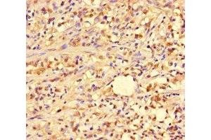 Immunohistochemistry of paraffin-embedded human gastric cancer using ABIN7144964 at dilution of 1:100 (PIF1 抗体  (AA 125-360))