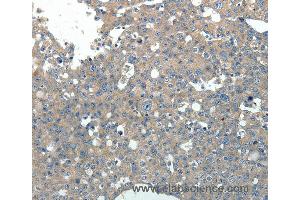 Immunohistochemistry of Human breast cancer using PVALB Polyclonal Antibody at dilution of 1:20 (PVALB 抗体)