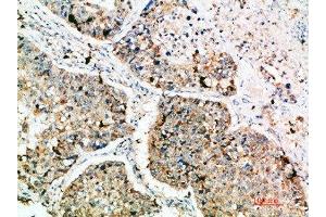 Immunohistochemical analysis of paraffin-embedded human-lung-cancer, antibody was diluted at 1:200 (LAMP3 抗体  (AA 261-310))