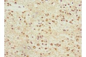 Immunohistochemistry of paraffin-embedded human glioma using ABIN7163952 at dilution of 1:100 (KCNA3 抗体  (AA 486-575))