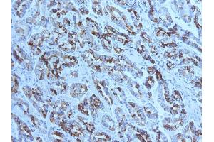 Formalin-fixed, paraffin-embedded human Gastric Carcinoma stained with MUC6 Mouse Monoclonal Antibody (CLH5). (MUC6 抗体)
