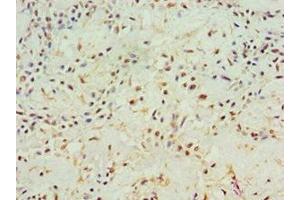 Immunohistochemistry of paraffin-embedded human breast cancer using ABIN7144000 at dilution of 1:100 (Aminoacylase 1 抗体  (AA 1-408))