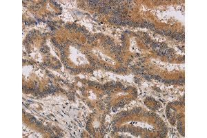 Immunohistochemistry of Human thyroid cancer using ITIH1 Polyclonal Antibody at dilution of 1:30 (ITIH1 抗体)