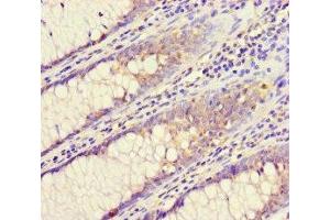 Immunohistochemistry of paraffin-embedded human colon cancer using ABIN7147525 at dilution of 1:100 (CHMP4C 抗体  (AA 1-233))