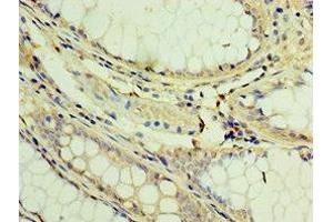 Immunohistochemistry of paraffin-embedded human colon cancer using ABIN7173394 at dilution of 1:100 (TGS1 抗体  (AA 714-853))