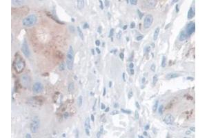 DAB staining on IHC-P; Samples: Human Breast cancer Tissue (Kallikrein 14 抗体  (AA 36-267))