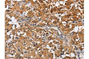 The image on the left is immunohistochemistry of paraffin-embedded Human thyroid cancer tissue using ABIN7128585(ATP1B2 Antibody) at dilution 1/30, on the right is treated with fusion protein. (ATP1B2 抗体)