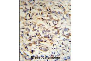CPN2 Antibody (RB18703) IHC analysis in formalin fixed and paraffin embedded human breast carcinoma tissue followed by peroxidase conjugation of the secondary antibody and DAB staining. (CPN2 抗体  (N-Term))