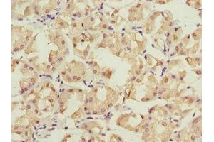 Immunohistochemistry of paraffin-embedded human gastric cancer using ABIN7142206 at dilution of 1:100 (PSMD12 抗体  (Regulatory Subunit 12))