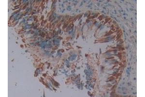 DAB staining on IHC-P; Samples: Human Lung cancer Tissue (SERPINB3 抗体  (AA 1-210))