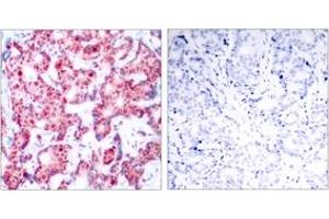 Immunohistochemistry analysis of paraffin-embedded human breast carcinoma, using GATA1 (Phospho-Ser142) Antibody. (GATA1 抗体  (pSer142))