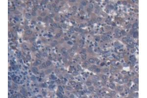 IHC-P analysis of Human Endometrial cancer Tissue, with DAB staining. (CD131 抗体  (AA 133-233))
