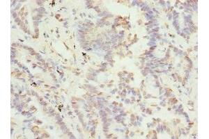 Immunohistochemistry of paraffin-embedded human lung cancer using ABIN7171838 at dilution of 1:100 (TSSK3 抗体  (AA 1-268))