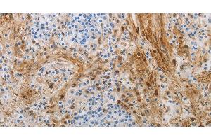 Immunohistochemistry of paraffin-embedded Human tonsil using NGFR Polyclonal Antibody at dilution of 1:50 (NGFR 抗体)