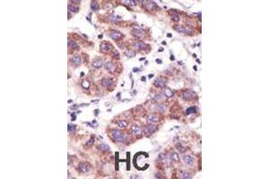 Formalin-fixed and paraffin-embedded human cancer tissue reacted with the primary antibody, which was peroxidase-conjugated to the secondary antibody, followed by DAB staining. (USP3 抗体  (N-Term))