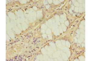 Immunohistochemistry of paraffin-embedded human breast cancer using ABIN7157126 at dilution of 1:100 (IPP Isomerase 2 抗体  (AA 1-227))