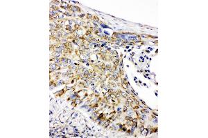 Anti-Prohibitin antibody, IHC(P) IHC(P): Human Lung Cancer Tissue (Prohibitin 抗体  (C-Term))
