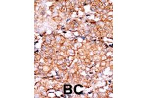 Formalin-fixed and paraffin-embedded human cancer tissue reacted with RAD9A (phospho S328) polyclonal antibody  which was peroxidase-conjugated to the secondary antibody followed by AEC staining. (RAD9A 抗体  (pSer328))