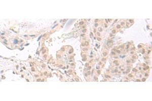 Immunohistochemistry of paraffin-embedded Human thyroid cancer tissue using HOOK2 Polyclonal Antibody at dilution of 1:30(x200) (HOOK2 抗体)