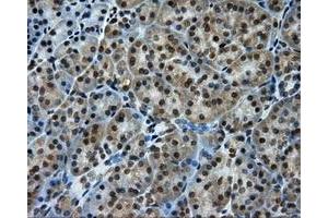 Immunohistochemical staining of paraffin-embedded Carcinoma of liver tissue using anti-PTPRE mouse monoclonal antibody. (PTPRE 抗体)