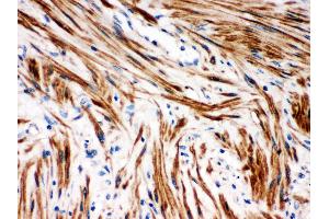 Anti- IKB beta Picoband antibody,IHC(P) IHC(P): Human Intestinal Cancer Tissue
