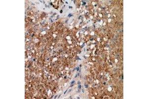 Immunohistochemical analysis of ALPK1 staining in human breast cancer formalin fixed paraffin embedded tissue section. (ALPK1 抗体  (N-Term))