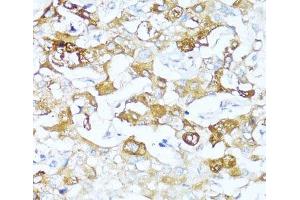 Immunohistochemistry of paraffin-embedded Human liver cancer using SERPINA3 Polyclonal Antibody at dilution of 1:100 (40x lens). (SERPINA3 抗体)