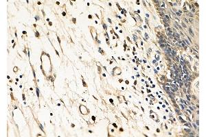 ABIN6260893 and ABIN6278559 at 1/100 staining Human esophageal cancer and adjacent non-tumor tissue by IHC-P.