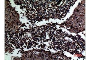 Immunohistochemistry (IHC) analysis of paraffin-embedded Human Lung Cancer, antibody was diluted at 1:100. (Galectin 3 抗体  (C-Term))