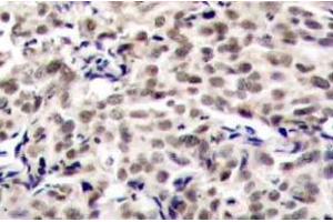 Immunohistochemistry (IHC) analyzes of CREB antibody in paraffin-embedded human breast carcinoma tissue. (CREB1 抗体)