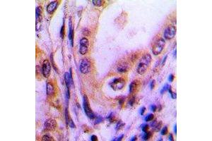 Immunohistochemical analysis of Thrombospondin 4 staining in human lung cancer formalin fixed paraffin embedded tissue section. (THBS4 抗体)