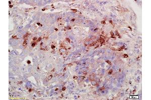Formalin-fixed and paraffin embedded human lung carcinoma labeled with Anti-FUCA1/Alpha L fucosidase I Polyclonal Antibody, Unconjugated (ABIN682003) at 1:200 followed by conjugation to the secondary antibody and DAB staining. (FUCA1 抗体  (AA 321-420))
