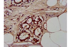 IHC image of ABIN7147581 diluted at 1:300 and staining in paraffin-embedded human breast cancer performed on a Leica BondTM system. (CLCNKB 抗体  (AA 538-687))